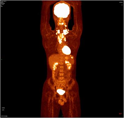 Insights into uveitis from Brentuximab vedotin in refractory Hodgkin’s lymphoma: a case report and brief review